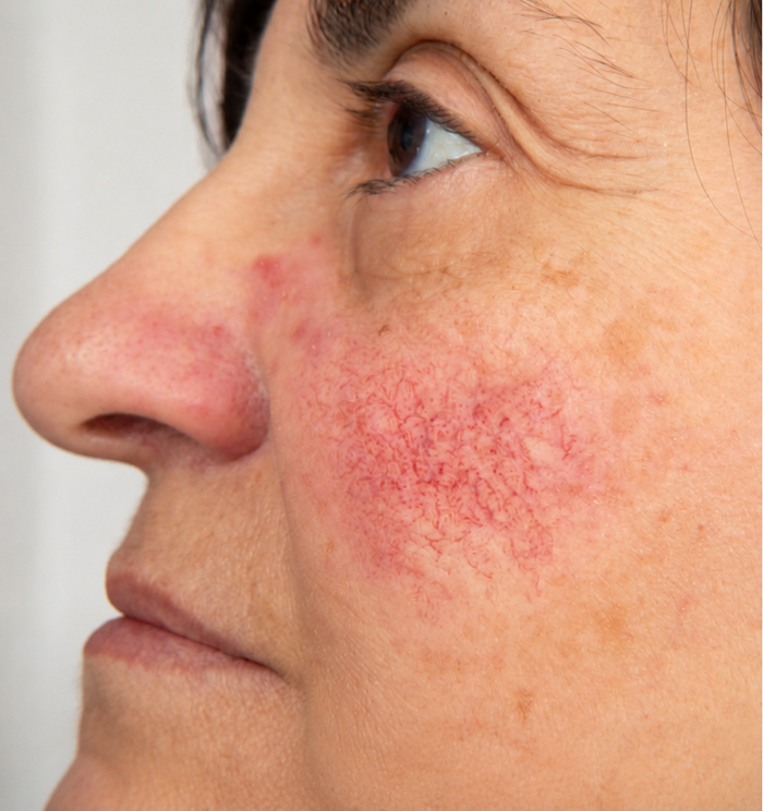 Less Puffiness